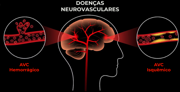 Clínica de Neurologia e Distúrbios do Sono - AVC Isquêmico e Hemorrágico